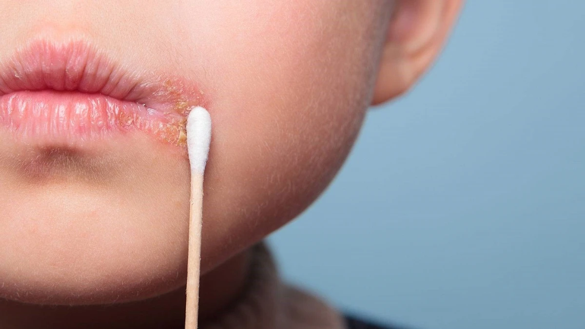 درمان‌های طبیعی تبخال