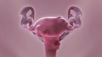 درمان فیبروم رحم در طب سنتی