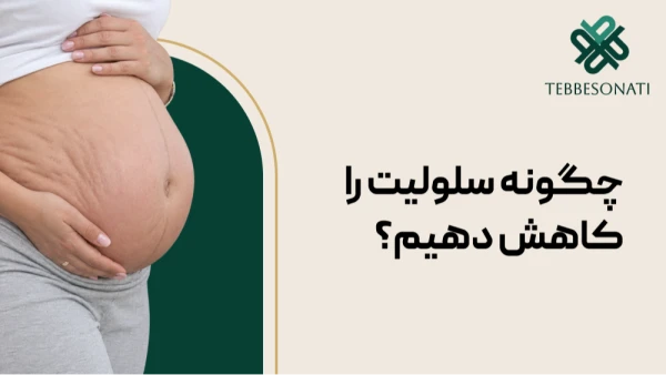 چگونه سلولیت را کاهش دهیم؟ بررسی روش‌های مؤثر برای درمان و رفع سلولیت